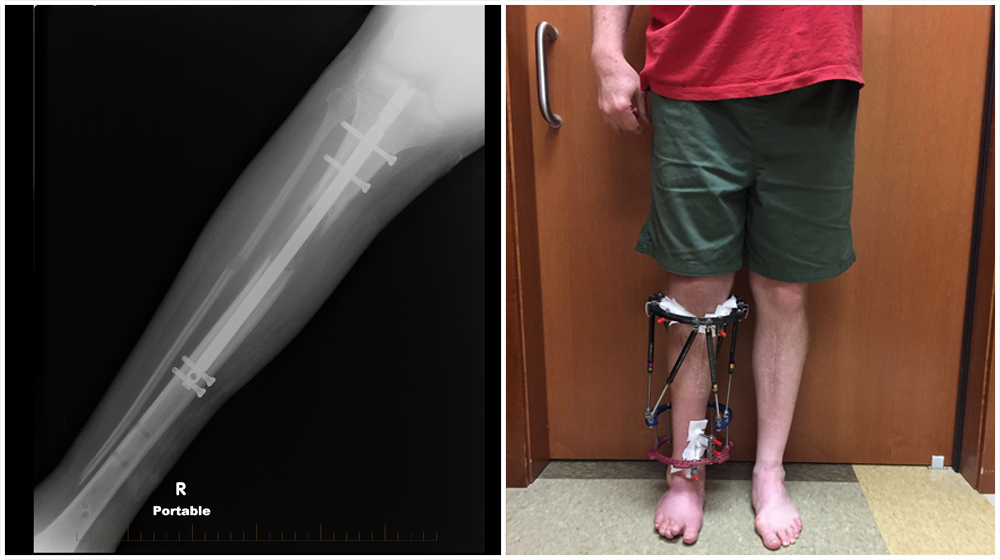 New limb-lengthening technique is less cumbersome for patients, study finds