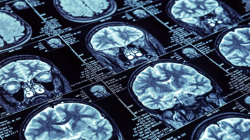 MRI scans of different human brains