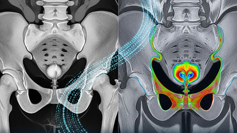 Prostate-segmentation